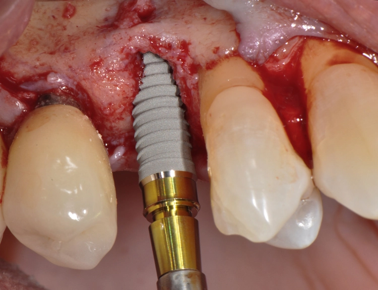 Abb. 9: Atraumatische Insertion des Implantats (Xive ø 3,8 mm) mit selbstschneidendem Gewinde.