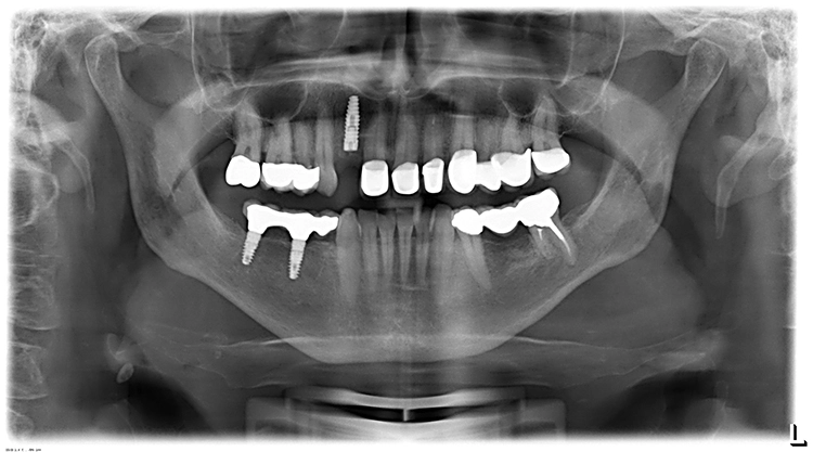 Abb. 23: OPG nach Implantation in regio 12 und drei Monate postoperative Kontrolle.