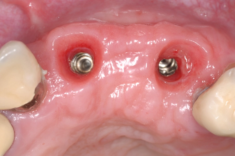 Abb. 17: Emergenzprofil regio 21 und 23 ausgeformt, Situation vier Wochen postoperativ mit individualisierten Gingivaformern.