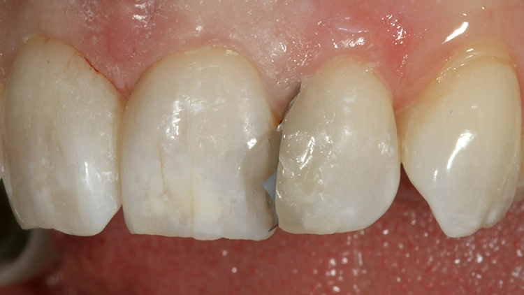 Abb. 20: Weiterer Aufbau in der Universalfarbe und inzisal-labial mit etwas Schmelzfarbe.