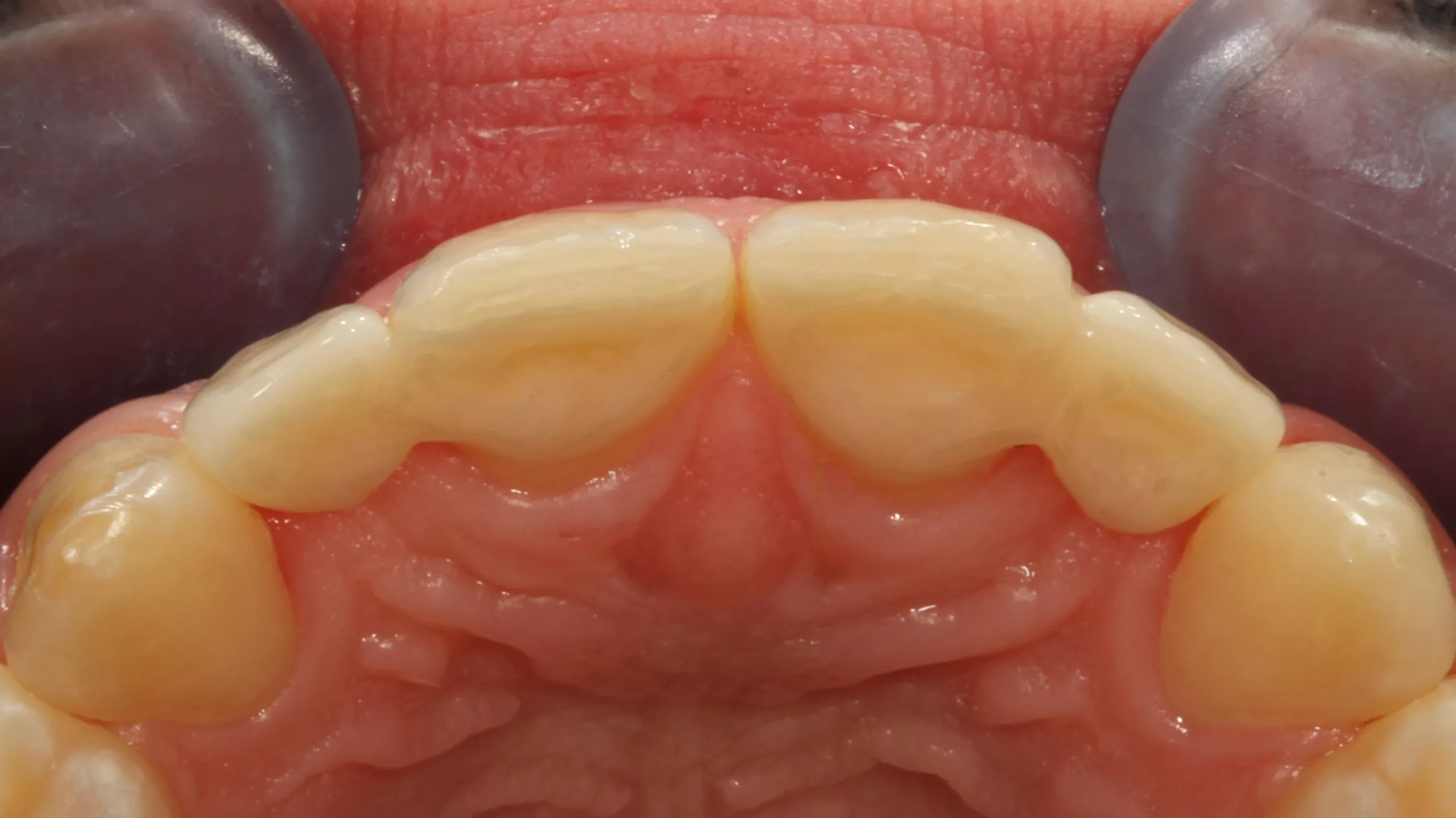 Abb. 52: Inzisalansicht der fertigen Versorgung.
