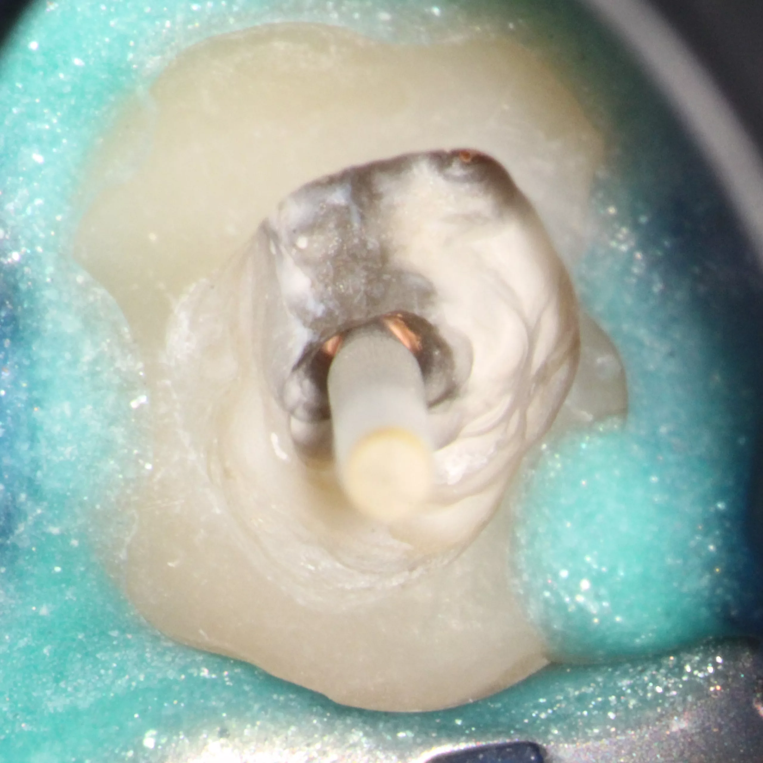 Abb. 56: Einprobe eines Glasfaserstiftes (EasyPost, Dentsply Sirona).