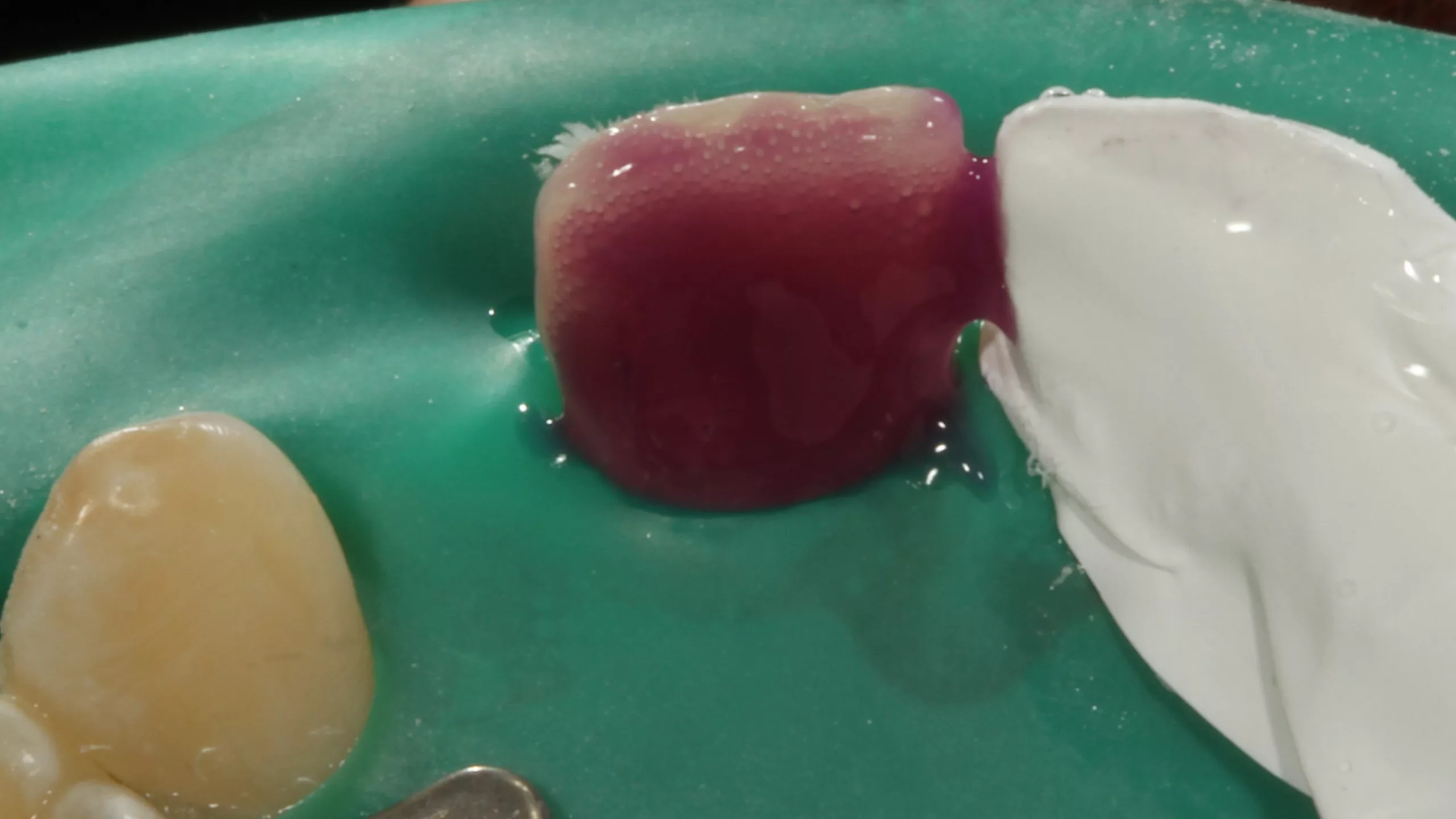 Abb. 46: Phosphorsäurekonditionierung der gesamten Klebefläche an Zahn 21.