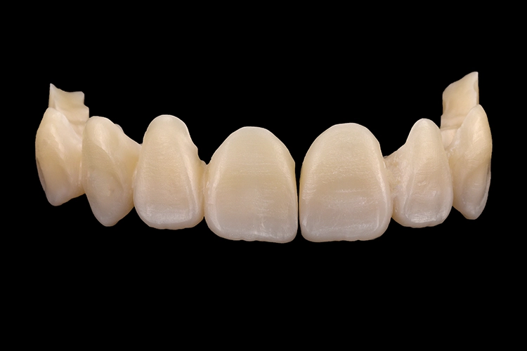 Abb. 10: Zustand der verblockten Kroneneinheiten aus dem polychromatischen und farbtreuen Zirkondioxid nach der Sinterung.