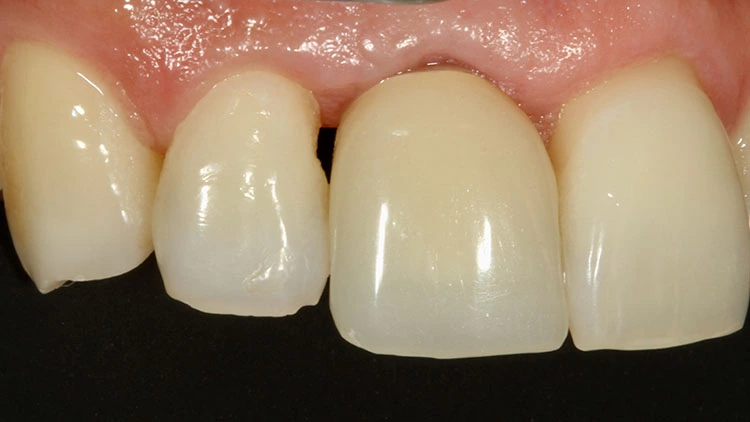 Abb. 22: PMMA-LZP auf Implantat 11, mesial-zervikaler Defekt an Zahn 12.
