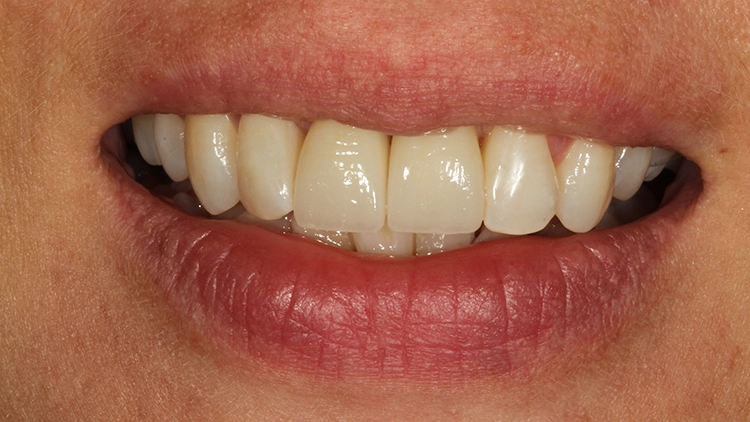 Abb. 15: Lippenbild der zufriedenen Patientin zum Behandlungsabschluss.