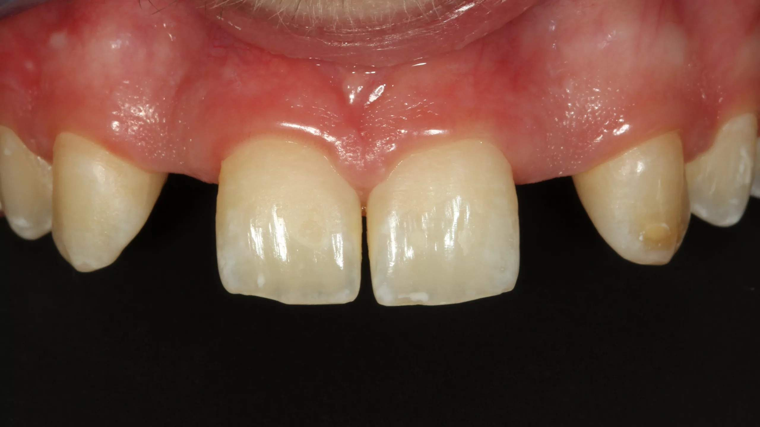 Abb. 37: Nichtanlage der beiden seitlichen Schneidezähne bei einem 14-jährigen Jugendlichen.