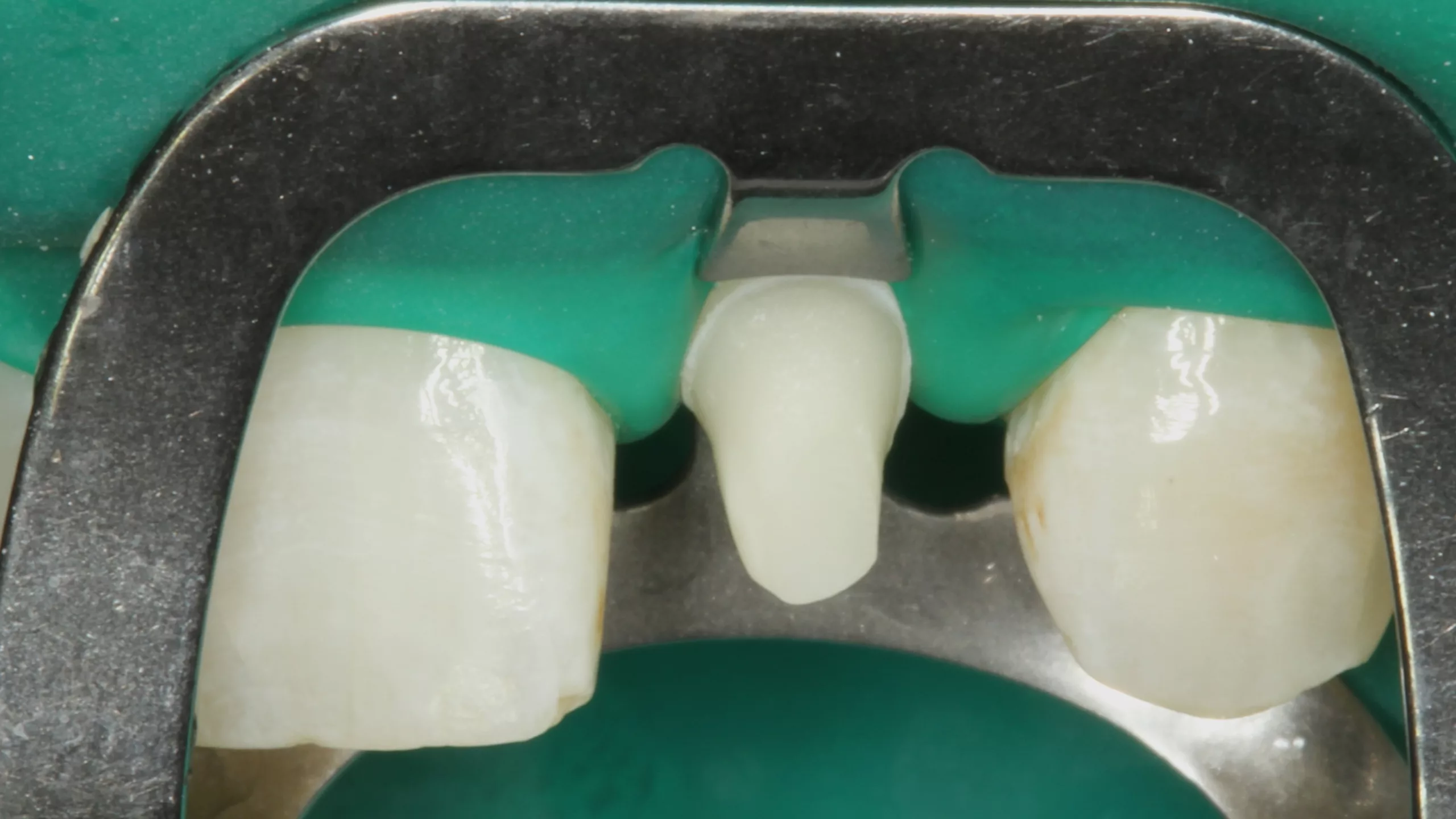 Abb. 22: Der konditionierte Zahnstumpf aus labialer Sicht.