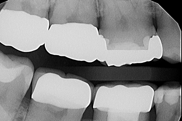 Abb. 32: Präoperative Bissflügelaufnahme: Das Goldinlay weist einen mesialen Randdefekt auf.