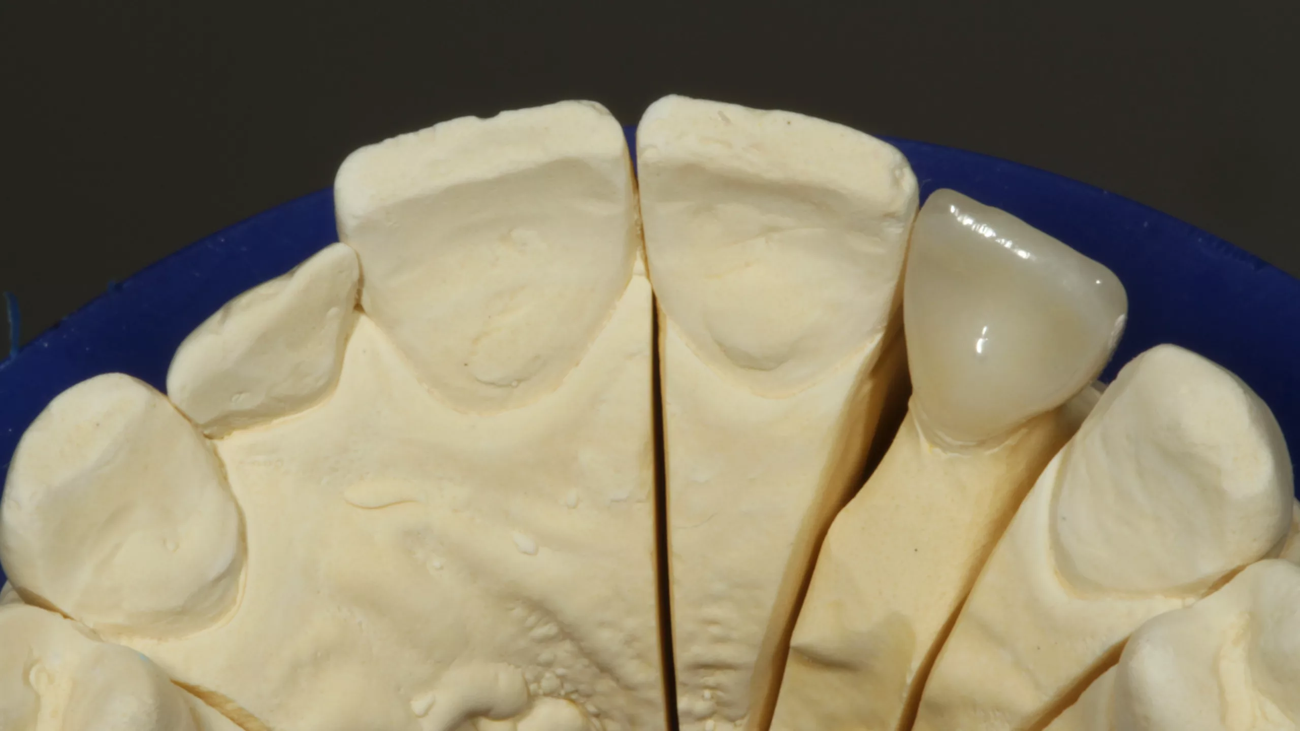 Abb. 14: Labial verblendete, monolithische Vollzirkonkrone. Ansicht auf dem Labormodell von inzisal.