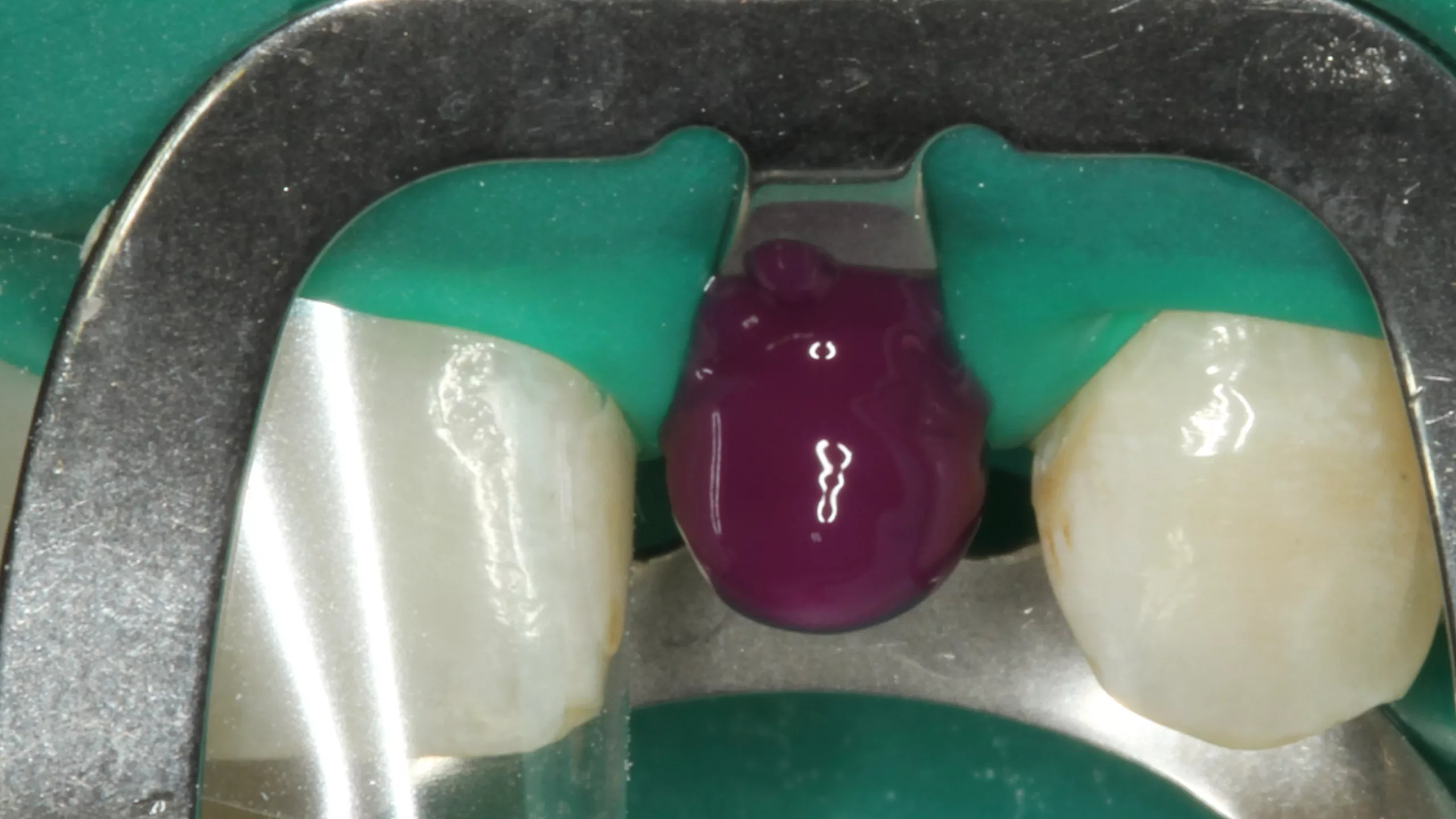 Abb. 20: Phosphorsäurekonditionierung der gesamten Klebefläche.