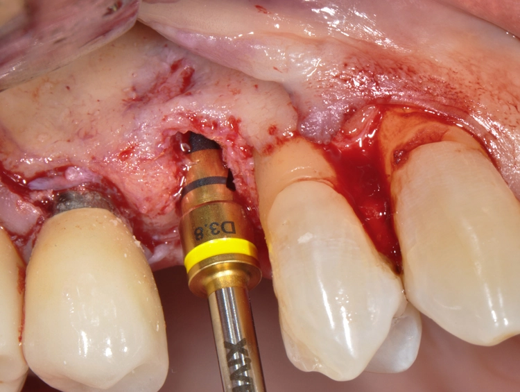 Abb. 7: Aufbereitung des Implantatbetts mit maximaler Schonung der vestibulären Knochenlamelle. Die Anodisierung der Bohrer und die Lasermarkierung sorgen
für eine gute Sichtbarkeit während der Aufbereitung.