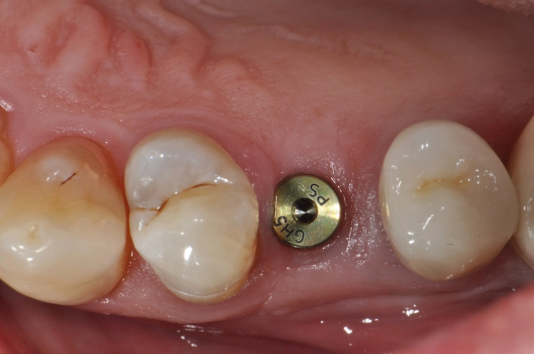 Abb. 14: Xive-PS-Gingivaformer der neuesten Generation. Die konkave Geometrie unterstützt den Erhalt des krestalen Knochens sowie zugleich eine ideale Adaption der Weichgewebe als trichterförmiges Emergenzprofil.