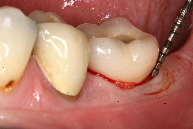 Abb. 1: Vorsichtige Taschenmessung bei periimplantärer Blutung am Implantat 37.