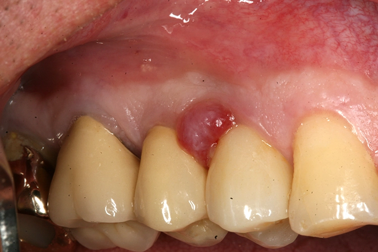 Abb. 2a: Exophytisch wachsende Weichgewebeproliferation am Implantat 14.