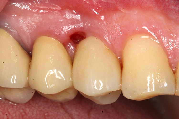Abb. 2b: Zustand eine Woche nach Entfernung der Neoplasie mit Kürettage des Knochens.