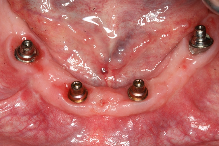 Abb. 3a: Reizlose Weichgewebebefunde mit geringer Anlagerung von Plaque an schwierig zu erreichenden Implantatbereichen.