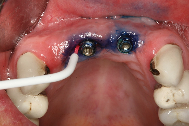 Abb. 4c: Antiinfektiöse Therapie mittels antimikrobieller Photodynamischer Therapie (HELBO, Bredent Medical, Walldorf) bei spontaner periimplantärer Blutung.