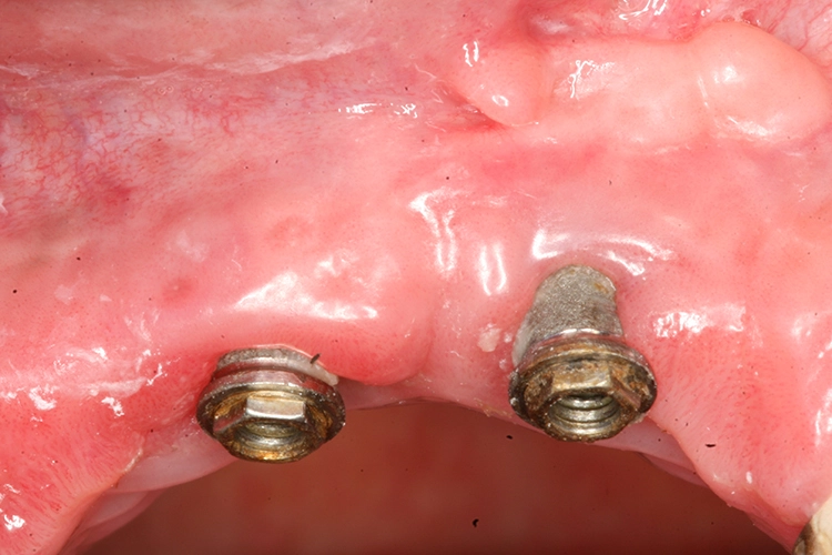 Abb. 4d: Remission der periimplantären Mukositis beim nächsten Recall nach 6 Monaten.