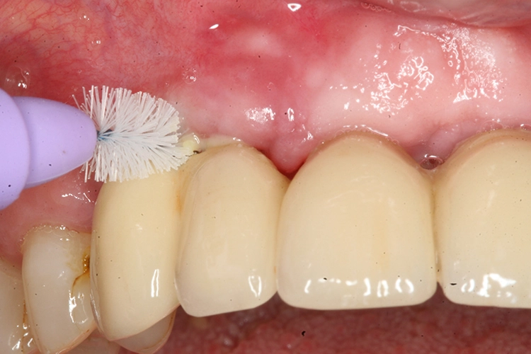 Abb. 5: Instruktion zur Anwendung von Interdentalbürstchen für die häusliche Mundhygiene.