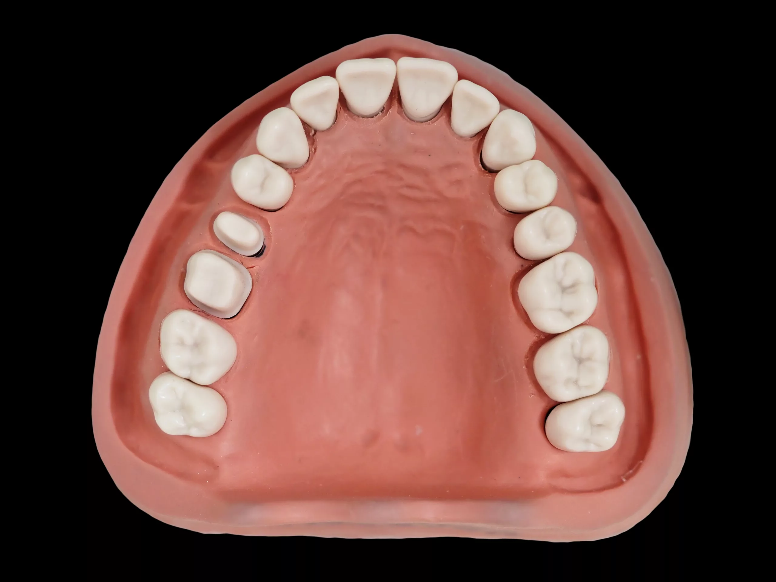 Abb. 5a: Oberkiefer mit supra- bzw. epigingivalen Hohlkehlpräparationen 15 und 16.