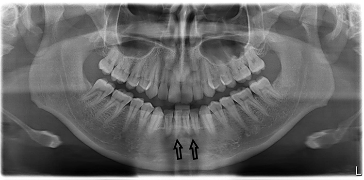 Abb. 1: PSA mit periapikalen Osteolysen in der Unterkieferfront.