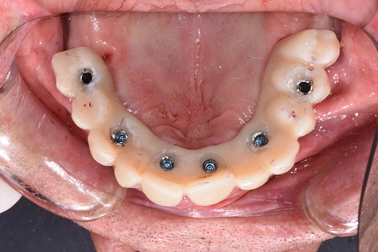 Abb. 10: Eingliederung des Sofortprovisoriums.