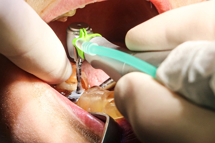 Abb. 10: Pilotbohrung Ø 2,0 mm bei der schablonengestützten Implantation.