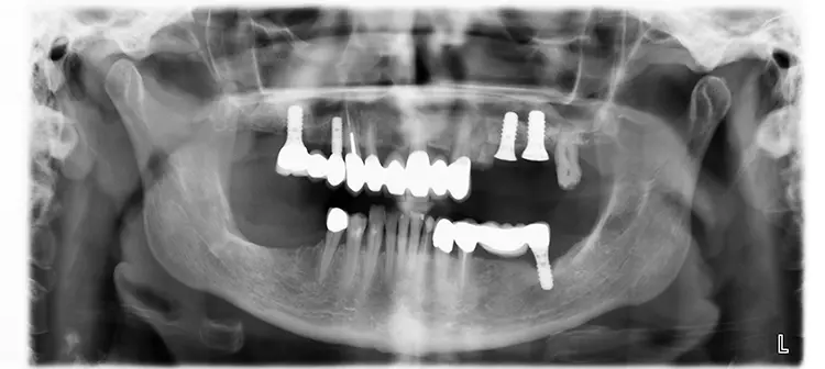 Abb. 10: DVT Implantat regio 16 kurz vor Explantation.