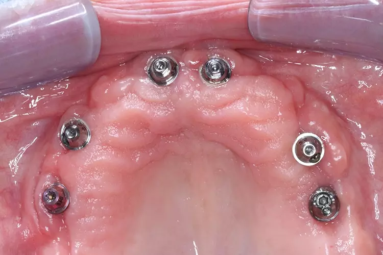 Abb. 11: Multiunit Aufsicht; 8 Wochen post OP, reizlose Gingiva im Obberkiefer.