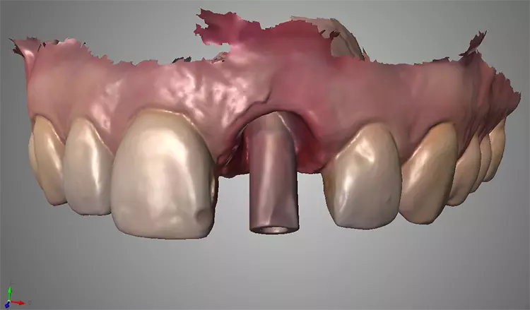 Abb. 11 und 12: Datensatz aus dem Intraoralscanner als Grundlage für das Herstellen der temporären Sofortversorgung regio 21.