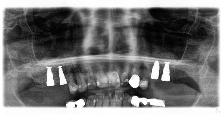 Abb. 11: OPG nach der Implantation.