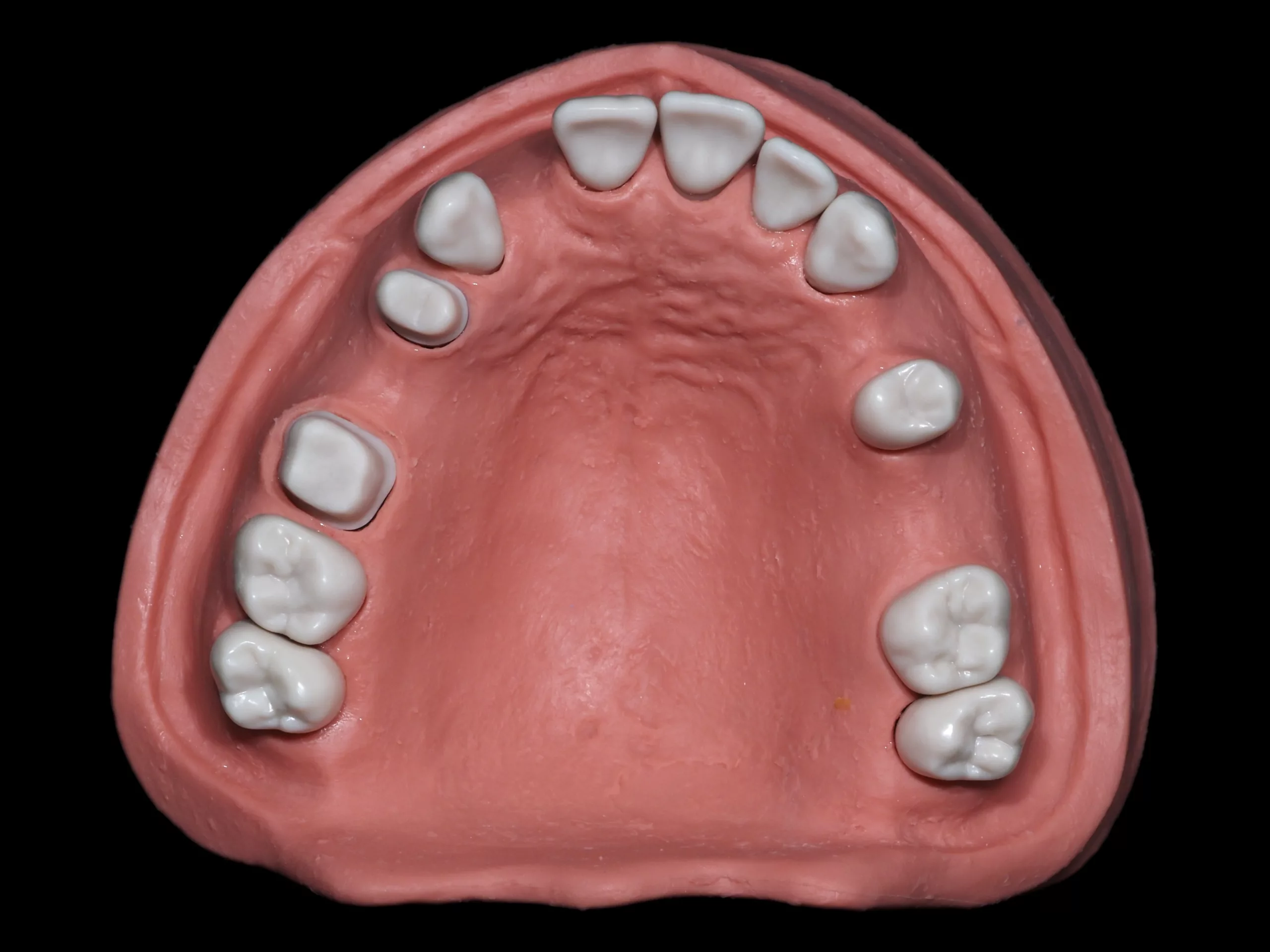 Abb. 11a: Oberkiefer mit supra- bzw. epigingivalen Hohlkehlpräparationen 14 und 16 mit gemeinsamer Einschubrichtung.