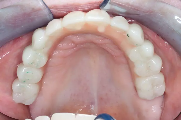 Abb. 12: Verschraubte Implantat getragene Brücke im Unterkiefer (Aufsicht).