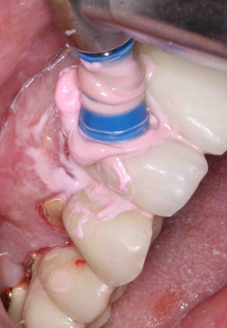 Abb. 12: Mechanisches Biofilmmanagement mit feiner Polierpaste und Cup.