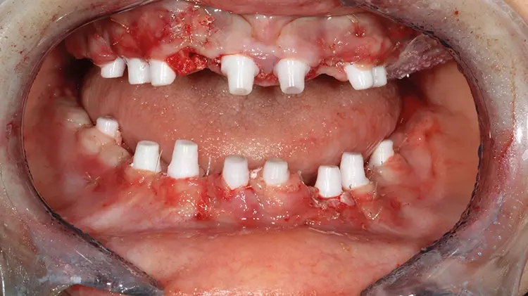 Abb. 13: Primärstabile, mittels schienenbasierter Navigation präzise inserierte SDS
Keramikimplantate im OK und UK in situ nach vollnavigierter Implantation mit
2ingis-Schienen. Alle einteiligen Implantate wurden direkt intraoperativ und intraoral
für die Langzeitprovisorien präpariert, die zweiteiligen wurden vorerst mit
einer Deckschraube verschlossen.