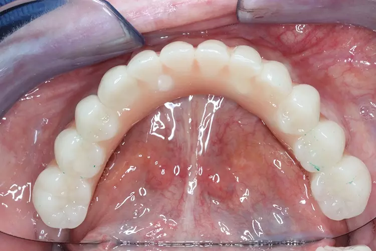 Abb. 13: Verschraubte implantatgetragene Brücke im Oberkiefer (Aufsicht).