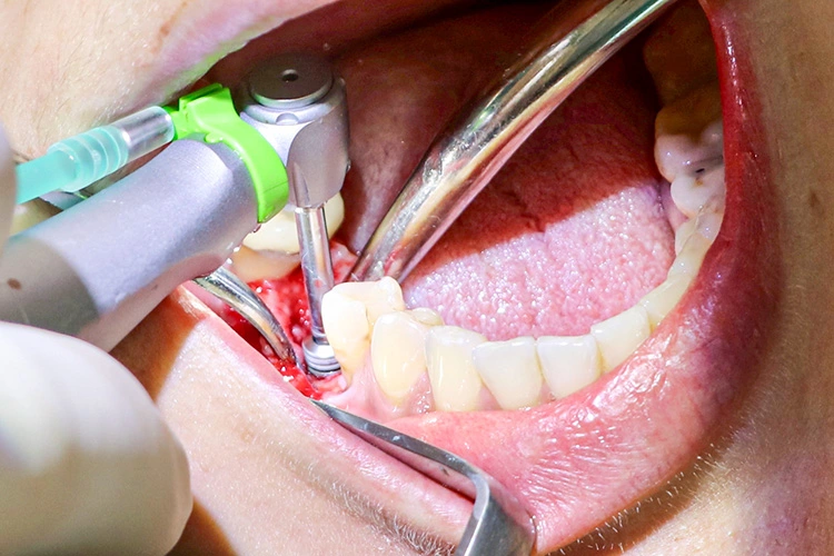 Abb. 13: Implantatinsertion in regio 46 mit 35 Ncm.