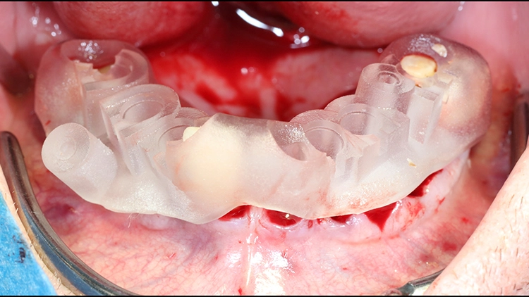 Abb. 13c: Die R2GATE-Guide-Schablone in situ, bereit für die Implantatbohrungen.