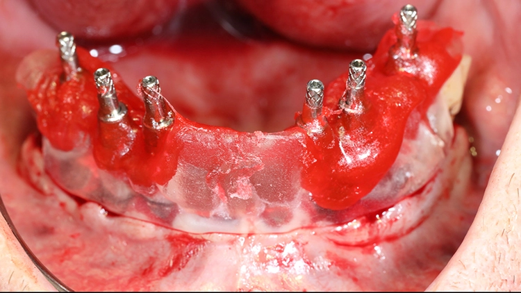 Abb. 13e: Die Implantate werden mit einem Autopolymerisat an die vertikal abgestützte Übertragungsschablone verbunden.