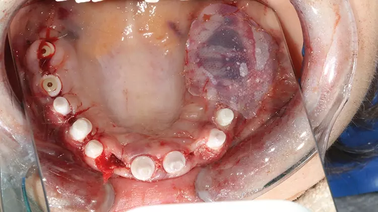 Abb. 14: Oberkiefer-Implantate entlang idealem Zahnbogen in situ, einschließlich
Abdeckung von regio 25/26 mithilfe einer sog. PTFE-Membran über dem BISSMesh
mit Implantat 26 (Open Healing Protocol nach Prof. Ghanaati).