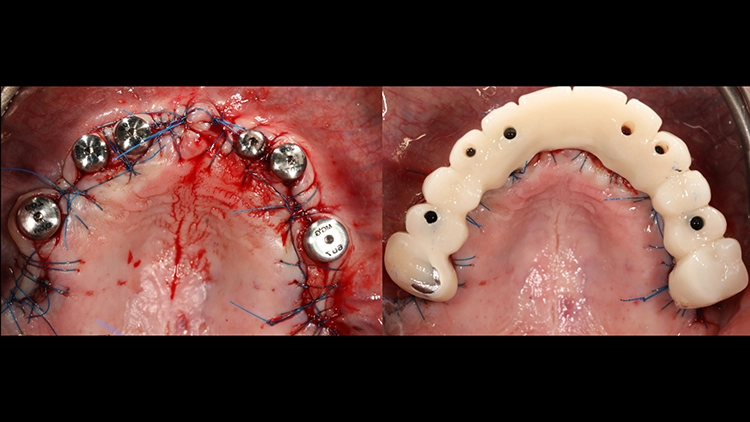 Abb. 14 a: Naht- und Wundverschluss mit Gingivaformern. Abb. 14 b: Eingesetztes Sofortprovisorium.
