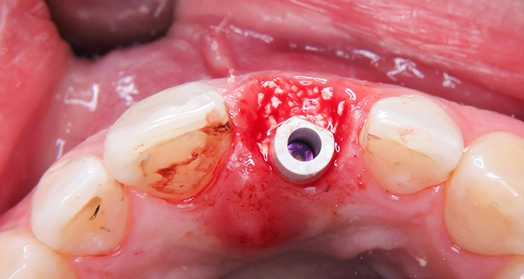 Abb. 14: Auffüllen des Spaltes zwischen Implantat und bukkaler Lamelle.