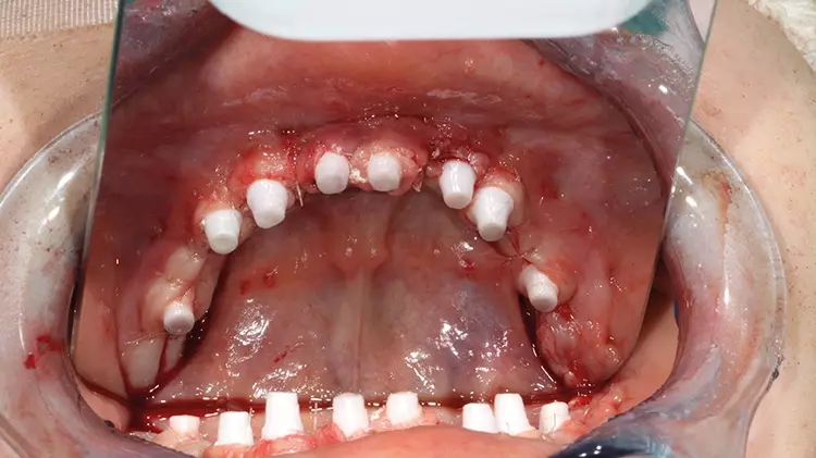 Abb. 15: Auch die UK-Implantate weisen trotz deutlicher Kieferkamm-Atrophie
und mit nur minimalinvasiven, einzeitigen Knochenaufbaumaßnahmen eine hohe
Primärstabilität auf.