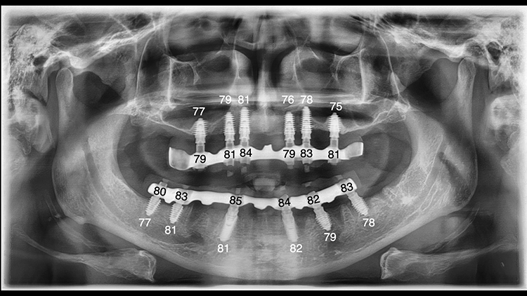 Abb. 15: OPG nach Sofortversorgung im Ober- und Unterkiefer mit ISQ-Messwerten.