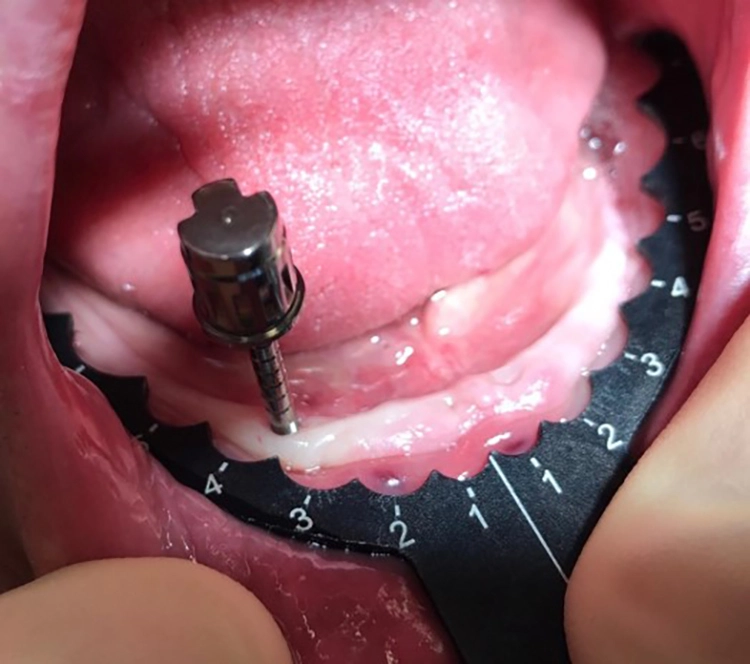 Abb. 15: Die CHAMPIONS Implant Guides sind sterilisierbar und an jeden Kiefer anpassbar.