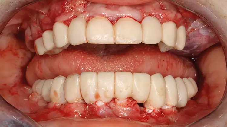 Abb. 16: Z. n. intraoperativer Wiederherstellung von Funktion und Ästhetik mithilfe von laborgefertigten, PMMA-Langzeitprovisorien auf den einteiligen
Implantaten.