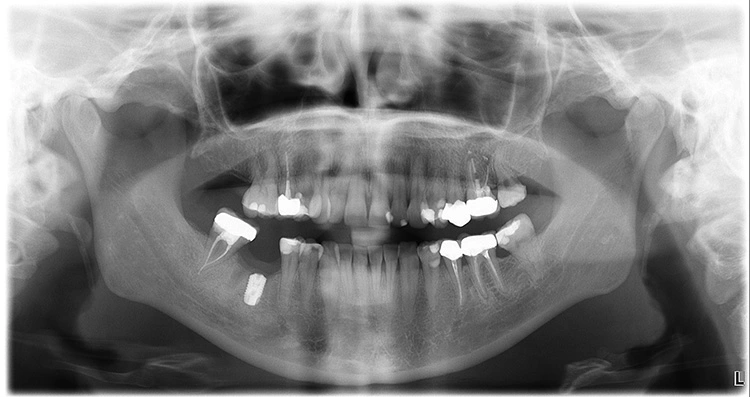 Abb. 16: Postoperatives Orthopantomogramm zur Kontrolle der Implantatposition.