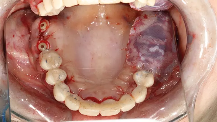 Abb. 17: Z. n. intraoperativer Wiederherstellung von Funktion und Ästhetik mithilfe von laborgefertigten, PMMA-Langzeitprovisorien auf den einteiligen
Implantaten.