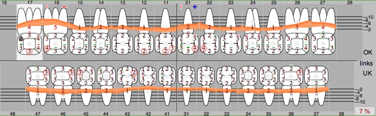 Abb. 17: Parodontale Situation zwölf Monate nach der Behandlung mit Straumann Emdogain® FL.
